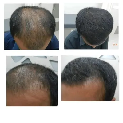 This before and after comparison shows significant hair restoration for a client with androgenetic alopecia. This transformation was achieved in three months with a customized medical treatment plan, proving that invasive procedures are not always necessary for effective hair regrowth.