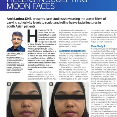 A look at my latest article in Prime Journal on the role of cohesive fillers in sculpting "moon faces" in South Asian patients, showcasing a before-and-after case study.