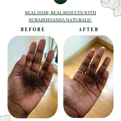 This is why I started Surabhidasha. This image shows the real, visible reduction in hair fall a client experienced after using my Protein Shampoo and Hibiscus Glow Conditioner. It’s not about magic, it’s about giving your hair the right natural nourishment.