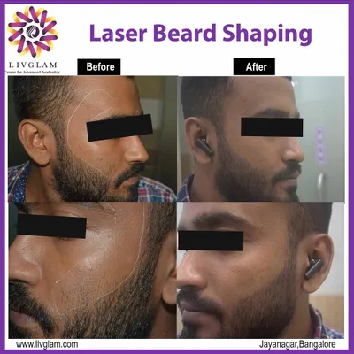 This before and after image shows the precise results of our laser beard shaping treatment. By targeting and removing stray hairs on the upper cheek, we achieve a sharp, clean beard line that requires no daily upkeep, saving time and preventing razor bumps.