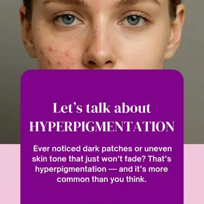 Let's talk about hyperpigmentation. If you have noticed dark patches or an uneven skin tone that just won't fade, you may be dealing with hyperpigmentation. It is a very common condition that I treat regularly in my clinic.