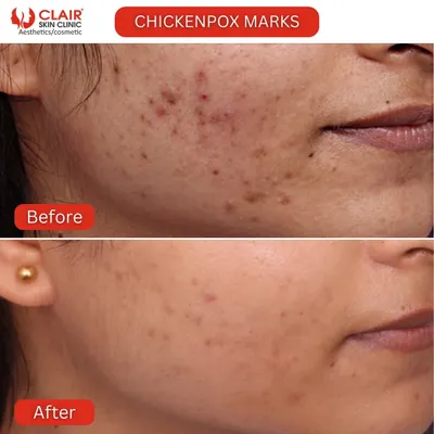 Stubborn chickenpox marks from childhood don't have to be permanent. This before and after shows a significant fading of pigmented marks and a smoothing of atrophic scars for much clearer skin.