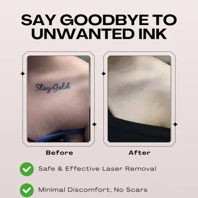 A clear example of our work. This client's collarbone tattoo was completely removed over several sessions, leaving no trace of the original ink. Our laser tattoo removal process is tailored to your skin for safe and complete results.