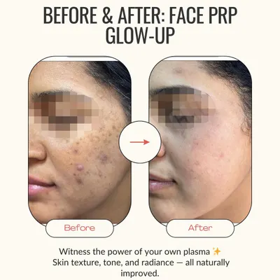 This client's journey with Face PRP is a testament to natural skin healing. After a few sessions, you can see a dramatic improvement in skin tone, a reduction in active acne and post-acne marks, and an overall healthier, radiant complexion.