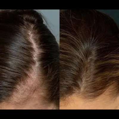 The results speak for themselves. This before-and-after image shows the significant increase in hair volume and scalp coverage a client achieved with a consistent PRP treatment plan. This therapy effectively thickens hair and reduces the appearance of thinning.