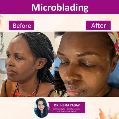 This before and after shows the transformative power of expertly done microblading. I mapped the brows to suit her face, then created fine, realistic strokes so they look full but not fake, achieving a hyper-realistic result.