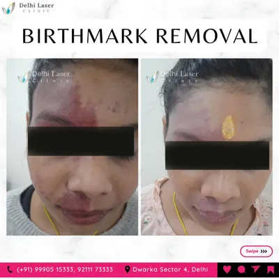 Another successful birthmark removal case. This before and after photo shows a significant reduction in a large pigmented birthmark on the face after a course of laser treatments.