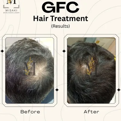 A clear example of successful GFC hair treatment. You can see the significant improvement in hair density on the crown area, a common site for male pattern baldness.