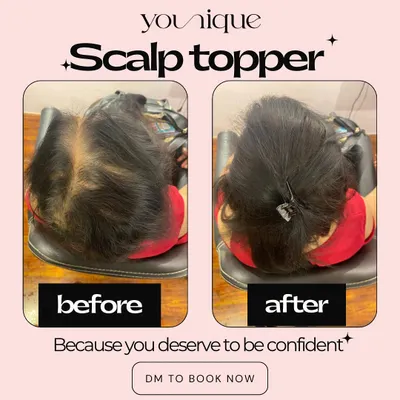 A picture is worth a thousand words. This before and after shows the immediate and powerful impact of a scalp topper, instantly concealing hair thinning and restoring fullness to the crown.