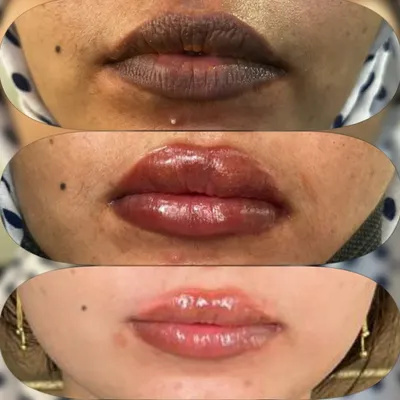 This three-part image shows the complete lip blush journey over two sittings. We started with dark, pigmented lips and achieved a beautiful, soft pink shade that looks completely natural and healthy.