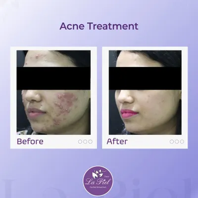 This before-and-after image showcases the journey from inflamed, persistent acne to clear, calm skin. Our treatment plans are designed to reduce irritation, clear breakouts, and restore the skin's natural health and balance.