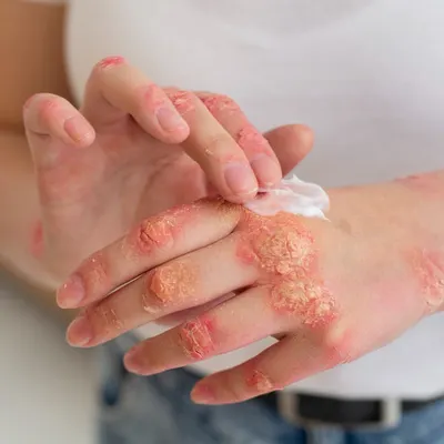 Psoriasis on the hands can be particularly debilitating. Treatment involves more than just creams; it's about finding a long-term management plan that calms inflammation and reduces flare-ups, allowing you to live more comfortably.