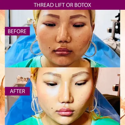 This patient wanted a more V-shaped and defined facial structure. I performed a non-surgical thread lift to lift the mid-face and sharpen the jawline, complemented by Botox injections for facial slimming. The after photo shows a significant improvement in facial contour.