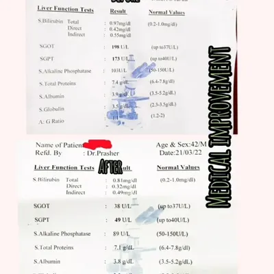This before and after report shows a client's liver function tests. In just one month, we successfully brought the SGOT and SGPT levels down from 198 and 173 to a healthy 38 and 49, respectively. This is a clear demonstration of food working as medicine.