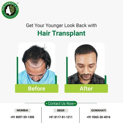 This before and after comparison clearly shows the journey from significant hair loss to a restored, younger look. The new hairline is designed to look completely natural, blending seamlessly with his existing hair.