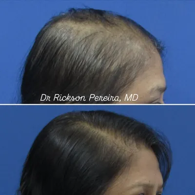 This side profile demonstrates significant improvement in hair density for a patient with female pattern hair loss. With a consistent, science-led treatment protocol, even advanced cases can see great results.