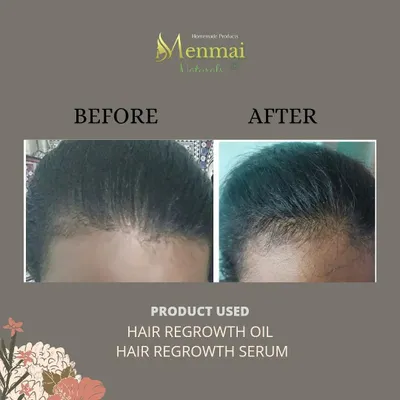 This photo shows the difference after just two weeks with my Hair Regrowth Serum and two months with the Hair Regrowth Oil. You can see the new, small baby hairs starting to fill in the hairline, which is a great sign of progress.