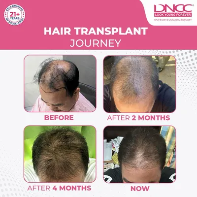 This patient's hair transplant journey shows the gradual but steady progress you can expect. From the initial stages to two months, four months, and the final result, you can see the density building up for a complete transformation.