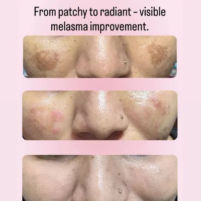 A fantastic example of visible melasma improvement. Our targeted treatments help break down stubborn pigmentation, leading to a more even and radiant skin tone.