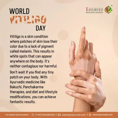 This graphic explains Vitiligo, a condition where skin loses pigment. Ayurveda identifies the root cause in doshic imbalance and accumulation of toxins. With therapies like Panchakarma and specific herbs, we can effectively manage this condition.