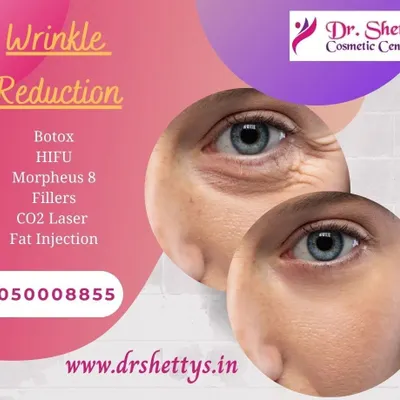 If you are concerned about fine lines and wrinkles, I offer several effective anti-aging treatments. This graphic shows the visible reduction in crow's feet, achieved through procedures like Botox, fillers, or advanced CO2 laser resurfacing for smoother, younger-looking skin.