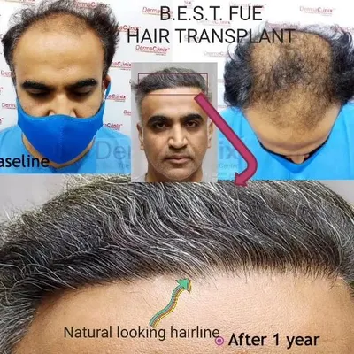 This collage shows the complete hair restoration journey one year after a B.E.S.T. FUE hair transplant. The focus on creating a natural-looking hairline is a critical part of my artistic and surgical approach to treating advanced baldness.