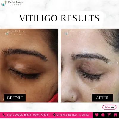This before-and-after shows the re-pigmentation of a vitiligo patch on the eyelid. With precise and consistent treatment, it is possible to restore color to affected areas, even on sensitive parts of the face.