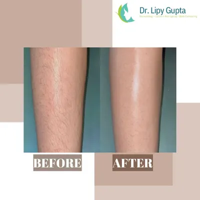 This before and after comparison for the legs clearly shows the transformation from noticeable, dense hair to smooth, clear skin. Laser hair reduction eliminates the need for daily shaving and leaves your skin feeling silky.