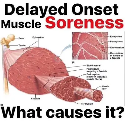 This diagram explains Delayed Onset Muscle Soreness (DOMS). We believe in educating our clients about what's happening to their bodies, explaining that this soreness is a normal part of muscle repair and growth, and sharing tips to alleviate it.