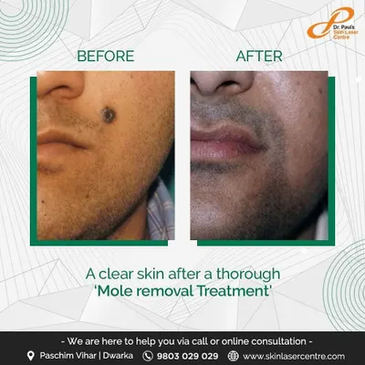 This before and after demonstrates a mole removal treatment. The procedure leaves the skin clear and smooth, addressing cosmetic concerns that such growths can cause.