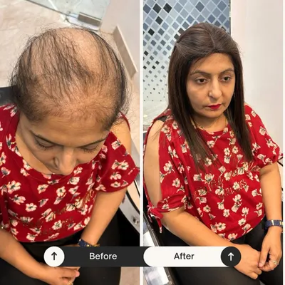 A powerful before-and-after transformation. This client was experiencing significant hair thinning, and our custom hair topper provided instant, natural-looking coverage and volume, completely changing her look and boosting her confidence.