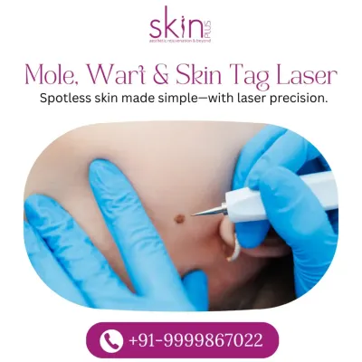 A close-up shot of a laser being used to remove a mole, illustrating the precision of the treatment. This service provides a simple solution for achieving spotless skin.