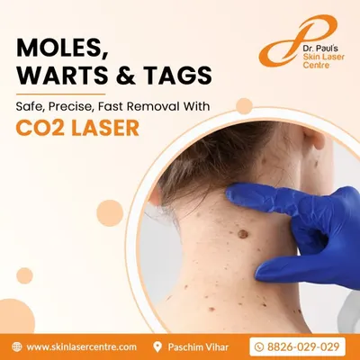 This image illustrates the common areas where skin tags and moles appear, such as the neck. My CO2 laser removal service is a safe, precise, and fast way to address these benign growths, providing a clear and smooth skin surface.