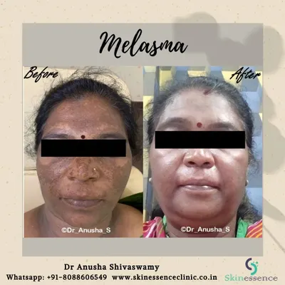 This is a powerful before-and-after of a client treated for severe melasma. After undergoing a Cosmelan peel treatment, you can see a remarkable clearance of the deep, patchy pigmentation across her face.