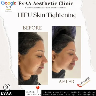 A real client's before and after profile, demonstrating the significant skin tightening and lift achieved with our HIFU treatment. The procedure effectively addresses sagging skin along the jawline for a more defined look.