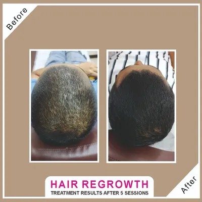 A top-down view showing a dramatic improvement in hair density for a client with male pattern baldness after 5 treatment sessions. The results speak for themselves.