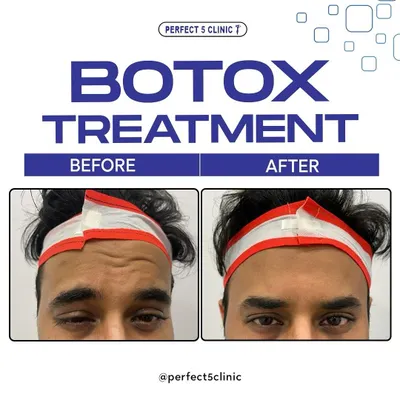 A clear before and after of our Botox treatment for forehead lines. Notice how the deep-set wrinkles are smoothed out, resulting in a more youthful and relaxed appearance.