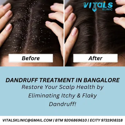 This before and after image shows the successful treatment of a flaky, itchy scalp. We offer effective dandruff treatments that restore scalp health by addressing the root causes, whether they are overactive oil glands, hormonal changes, or stress.
