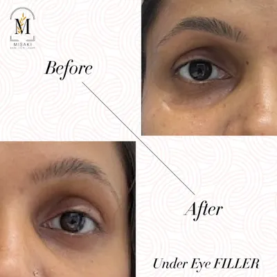 Tired-looking eyes can be effectively treated with under-eye fillers. This before and after shows how filling the hollows can instantly make you look more rested and refreshed in a single sitting.