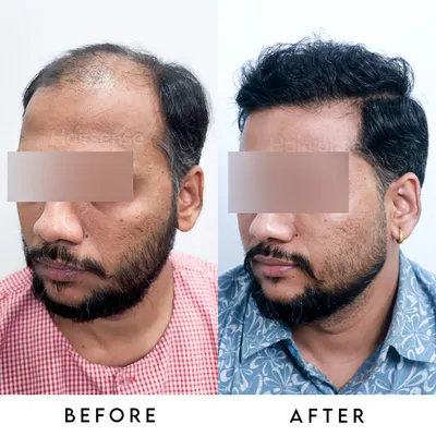 A comprehensive before and after view showing the significant improvement in density and the creation of a youthful, natural hairline.
