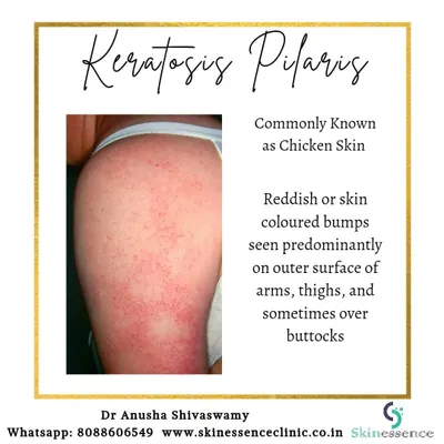 This is Keratosis Pilaris, commonly known as "chicken skin." It presents as reddish or skin-colored bumps on the arms and thighs, giving the skin a rough, sandpaper-like texture. It is a harmless but common cosmetic concern.