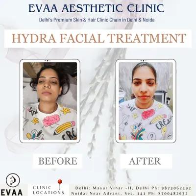 A real client's before-and-after photos following a HydraFacial treatment, showcasing a brighter, refreshed, and more radiant complexion.