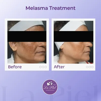 Melasma presents as dark, irregular patches on the face and requires a careful, sustained treatment approach. This before-and-after shows a significant reduction in melasma, revealing a clearer and more even complexion after a customized treatment plan.