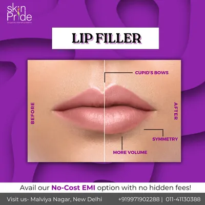 A look at the beautiful, natural-looking results of our lip filler treatment. This before and after comparison highlights how we enhance volume, define the cupid's bow, and create better symmetry for a balanced and confident smile. Our goal is always to enhance your unique features.