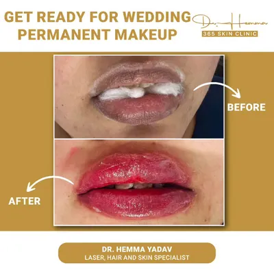 This client was getting ready for her wedding and wanted a lasting, natural lip color. The 'before' shows the numbing cream application, and the 'after' reveals the beautifully blushed and defined lips immediately post-procedure.