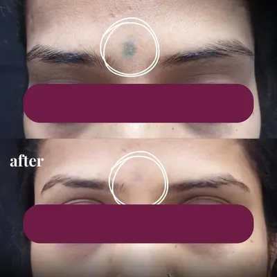 Here you can see the significant fading of a facial tattoo after a course of laser tattoo removal sessions. My approach focuses on gradually breaking down the ink pigment with each treatment, allowing the body to clear it naturally. This ensures the skin's integrity is protected while achieving clear, impressive results.