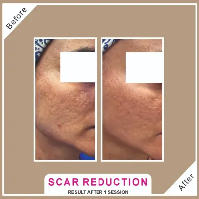 This before and after shows a significant reduction in acne scarring after just one session of a combination treatment. CO2 laser and MNRF are my gold-standard technologies for remodeling the skin and delivering fantastic results.