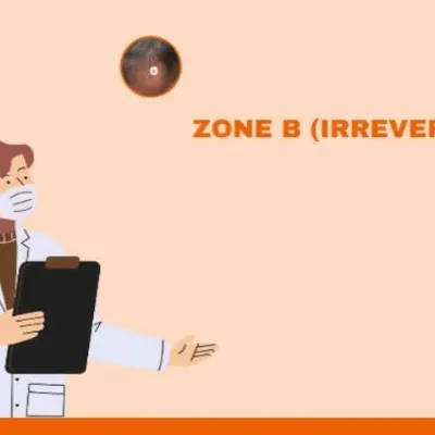 Understanding the stage of your hair loss is the first step. This graphic illustrates the two zones of male pattern alopecia. Zone A represents reversible thinning where medication can be effective, while Zone B shows irreversible loss where an FUE hair transplant is the recommended solution.