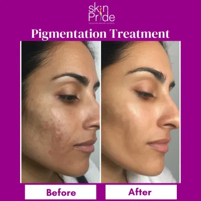 This before-and-after shot shows the real, visible change we can achieve for pigmentation issues. We create a personalized treatment plan to help you get clear, even-toned skin you can feel confident in.