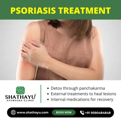 Our Ayurvedic Psoriasis treatment goes beyond surface-level care. We use a three-pronged approach: detoxification through Panchakarma, external treatments to heal lesions, and internal medications for a complete recovery.